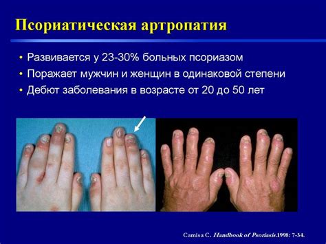 Диагностика псориатического артрита - рентген и другие методы исследования
