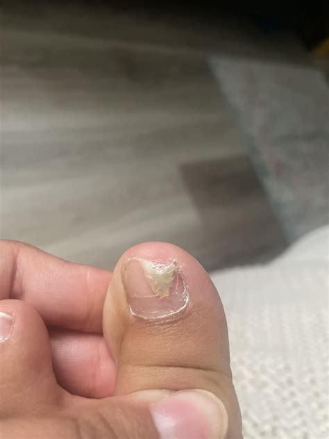 Someone stepped on my toe a while back and half my nail broke off. Now