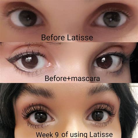 Latisse Eyelash Growth Serum Eye Color Change – Warehouse of Ideas