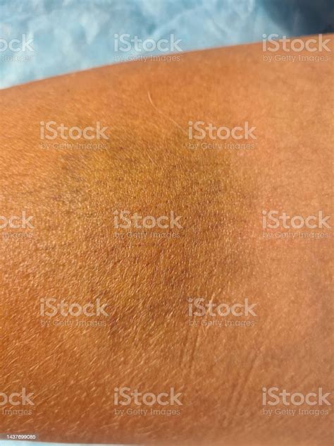 Closeup Bruise On Skin Of Person Is Blue Yellow In Color Stock Photo - Download Image Now - iStock