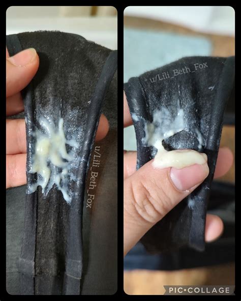 White Clumpy Discharge