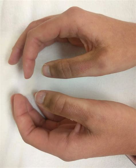 Photodermatitis: why there is an allergy to the sun - Healthy Food Near Me