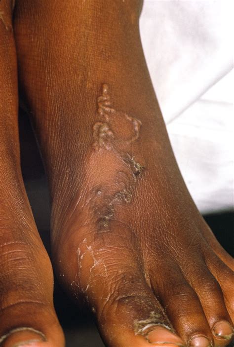 Hookworm Infection - Infectious Diseases - Merck Manual Professional