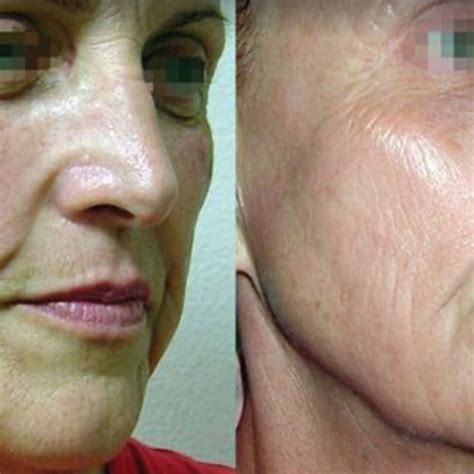 Pixel RF & Pixel Treatment | Laser Skin Resurfacing | Vancouver WA