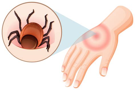 Tick bite human hand 295578 Vector Art at Vecteezy
