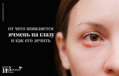 Ячмень на глазу. Причины появления и лечение
