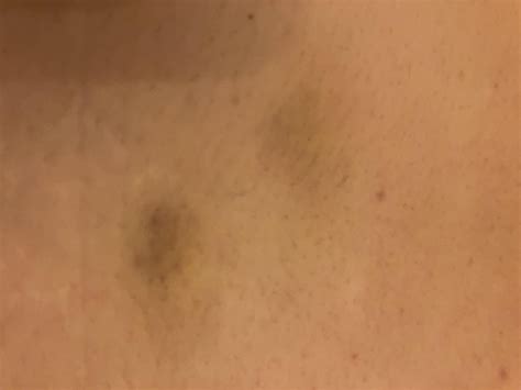 Weird spots on skin : r/DermatologyQuestions