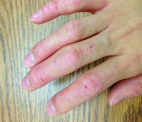 Dyshidrotic Eczema (Dyshidrosis): Causes, Pictures, And, 49% OFF