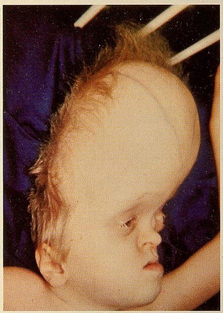 Hydrocephalus - Wikipedia