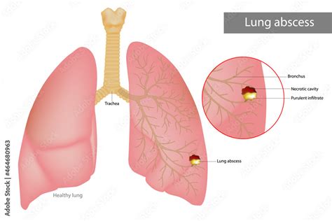 Lung abscess is a type of liquefactive necrosis of the lung tissue ...