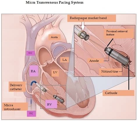 leadless pacing current status  ongoing developments