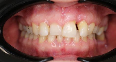 Клинические случаи по лечению диастемы элайнерами Star Smile