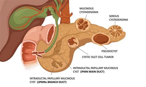 Pancreatic Cysts Treatment In SG | United Gastro and Endoscopy Clinic