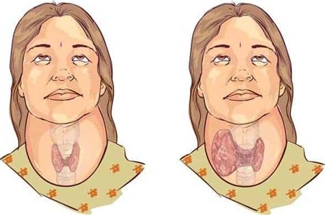 goitre classification pathology