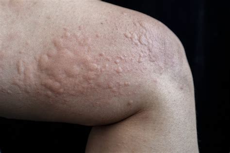 Chronic Spontaneous Urticaria or Chronic Hives | Oregon Medical