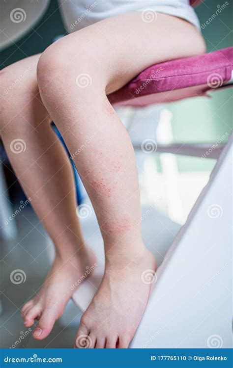 Close-up Eczema Atopic Dermatitis Symptom with Infected Skin on Child ...