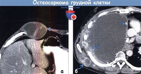 Остеосаркома грудной клетки на рентгенограмме, КТ