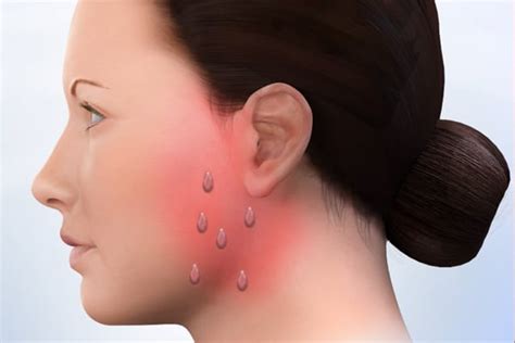 Parotid Gland Tumor & Salivary Stone Surgeons, Los Angeles CA