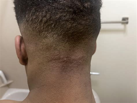 Got these bumps on the back of head after haircut. What do I do to stop