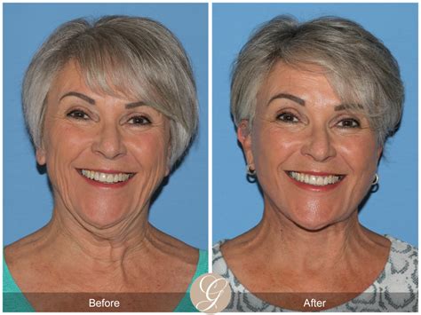 The Difference Between Deep Plane Facelift and SMAS Facelift | Sadati, MD