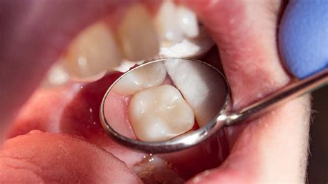 Molar Pain: Causes and Treatment - Parkdale Family Dental