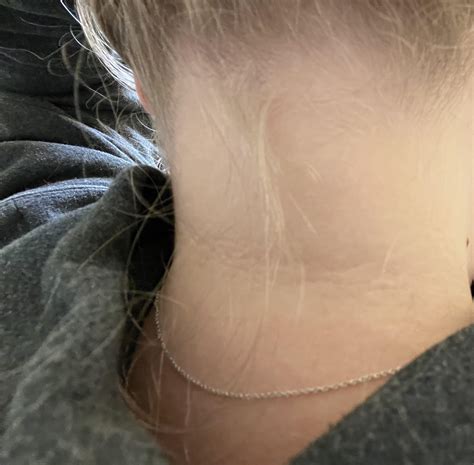 how to rid of neck lines 1