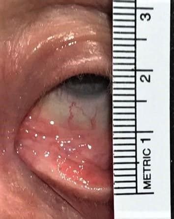 clinical guide  ectropion