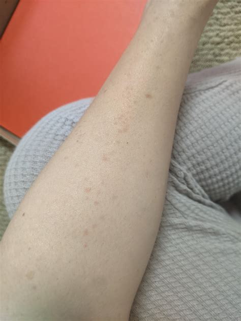 Rash on forearm : r/DermatologyQuestions