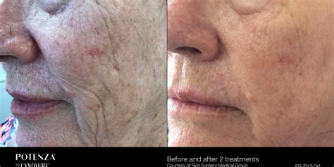 CynoGlow: Combining Potenza and Picosure to Target Your Top Skin ...