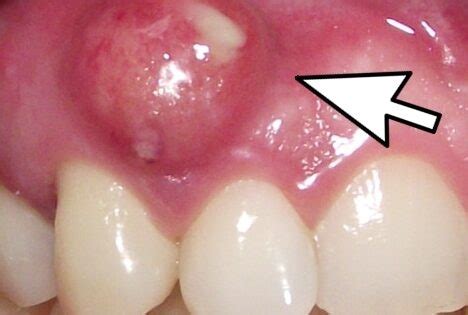 Descubre la pastilla ideal para aliviar el dolor de muela de forma efectiva