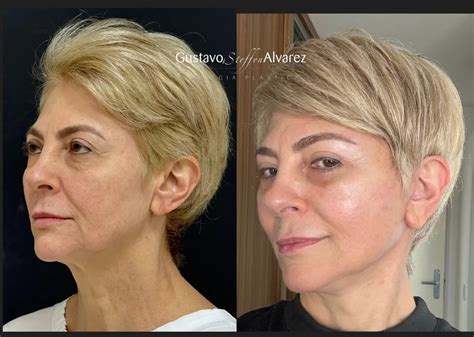 Lift Facial Antes E Depois Mulher De 27 Anos