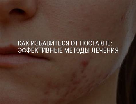 Как избавиться от постакне в домашних условиях: методы лечения постакне