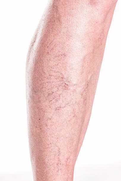 Spider Veins Legs Stock Photos, Pictures & Royalty-Free Images - iStock