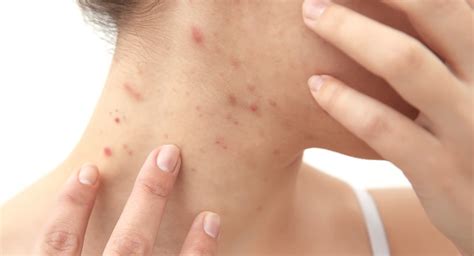 Neck Acne: Causes, Prevention, Treatments You Should Know — Clarion ...