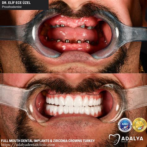 full mouth dental implants cost with insurance 5