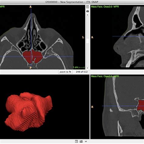 Example of segmentation of sphenoid sinuses from a head CT scan ...