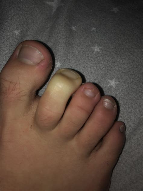 Why Are My Feet White And Numb at Imelda Metzger blog