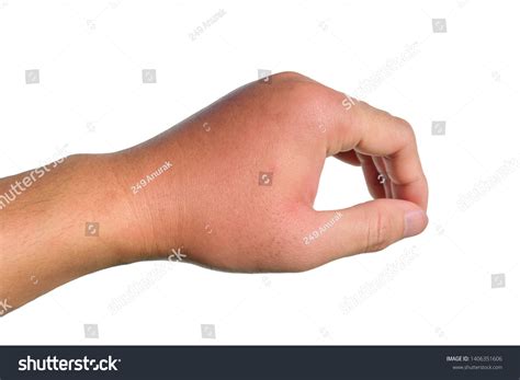 Bee Sting Infection Hand
