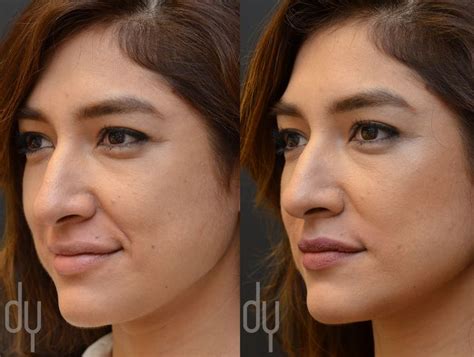 treating nasolabial fold smile lines  juvederm