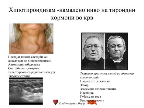 PPT - Тироидна жлезда, анатомија , патологија и методи на дијагностика ...