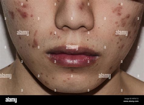 acne face  res stock photography  images alamy
