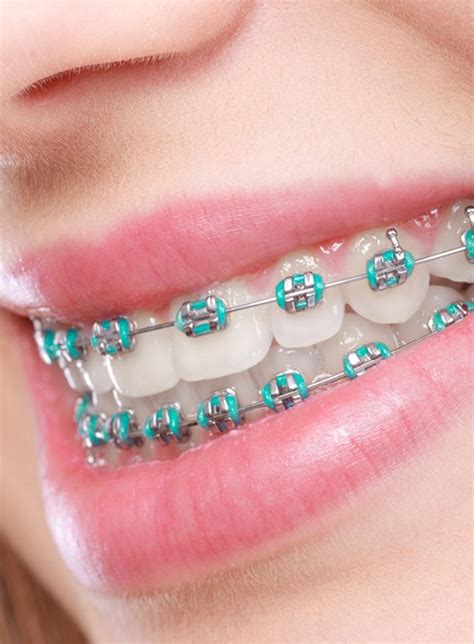 Traditional Braces Dallas, TX | Dental Center Of Lakewood