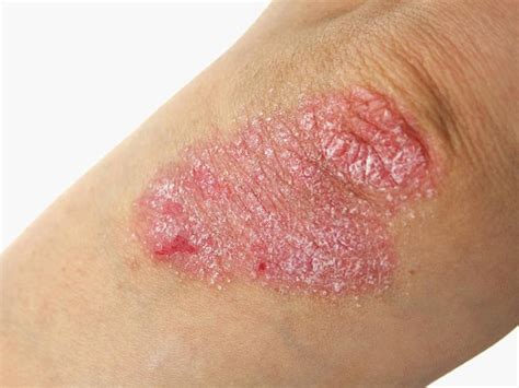 Gejala Psoriasis Baik yang Umum Maupun Sesuai Jenisnya