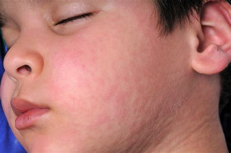 Urticaria Treatment | London Allergy Care & Knowledge