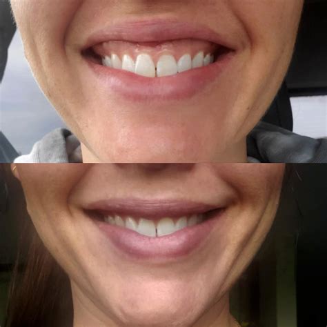 Botox, Daxxify, Dysport, Jeuveau | Before and After |Ann Arbor