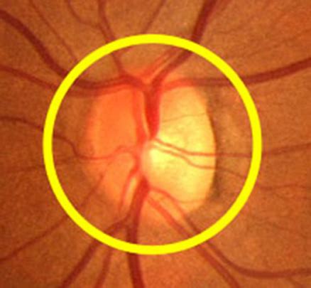 Ophthalmoscope View How To Use An Ophthalmoscope Mind The Bleep