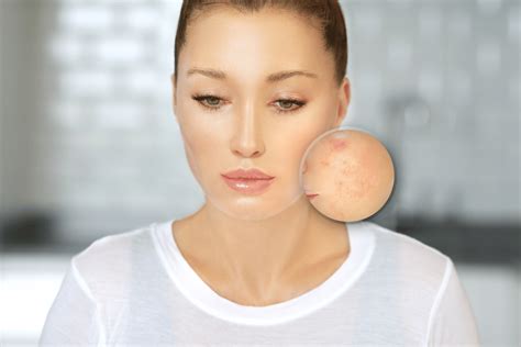 Trattamento di rigenerazione cicatrici acne La Spezia- Chirurgia