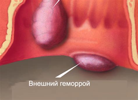 Острый тромбоз наружного геморроидального узла фото