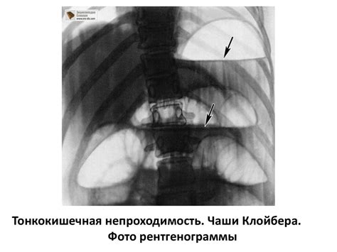 Острая кишечная непроходимость - презентация онлайн