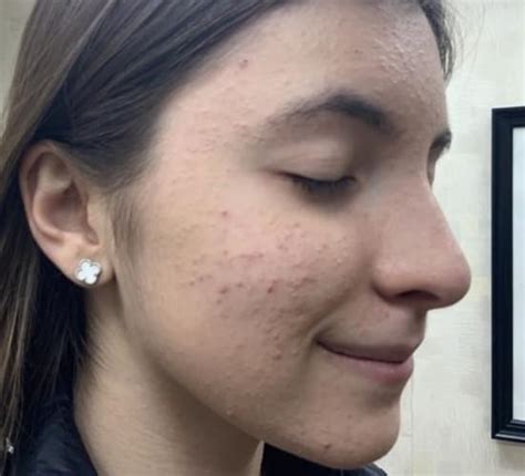 Before & After Gallery Acne | Pediatric And Adult Dermatology located ...